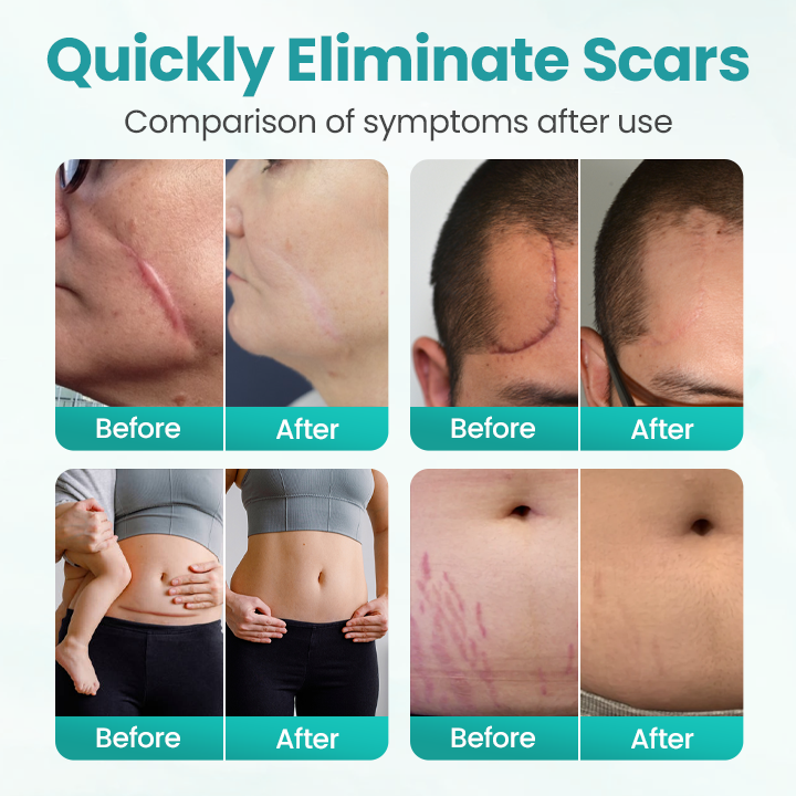 ⏰ Last Day Promotion 60% OFF 🔥 Cvreoz® EliteAloe ScarSolve Spray