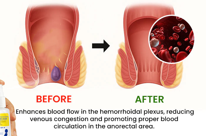 đ„Hot Sale - 60% OFFđżCvreozÂź Herbal Hemorrhoids Fast-Acting Treatment Spray