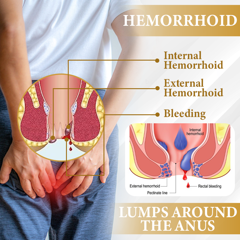 đ„ Sale up to 60% - Order NOW! đ„ CvreozÂź Apis Venom Hemorrhoid Cooling Spray
